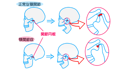 なぜ顎関節症になるのか?