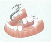 部分入れ歯の場合