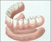 総入れ歯の場合